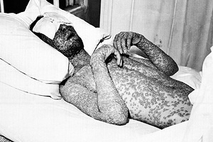 Поедающая плоть бактерия захватила американский штат